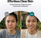 ELLE Magnesium Soft Acne Patch | Spot Treatment | Magnesium - The Magic Mineral |Hydrocolloid |Madecassic Acid | Tee Tree Oil Pimple Patches | Post-Breakout Acne Care | 11mm & 10mm Sizes | 45 Patches