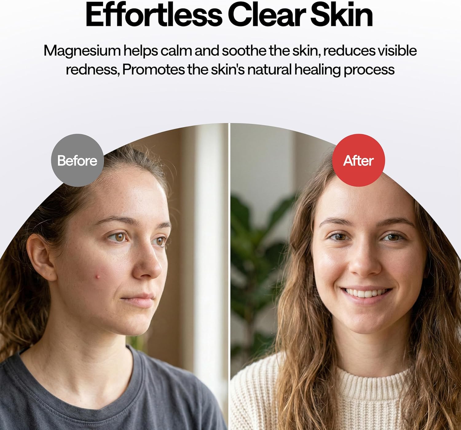 ELLE Magnesium Acne Patch |Micro-Dart | Magnesium - The Magic Mineral | Deep Penetrating Hydrocolloid Pimple Patch | Early Stage & Pus Pimples | Tea Tree & Madecassic Acid | 10 Patches